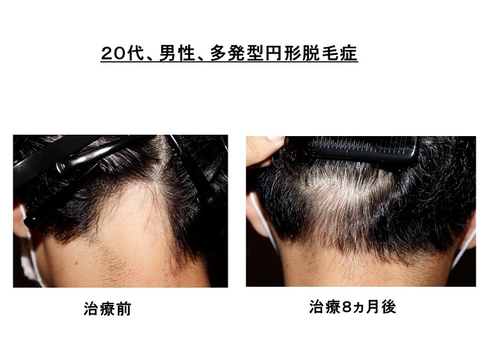 円形脱毛症　病院